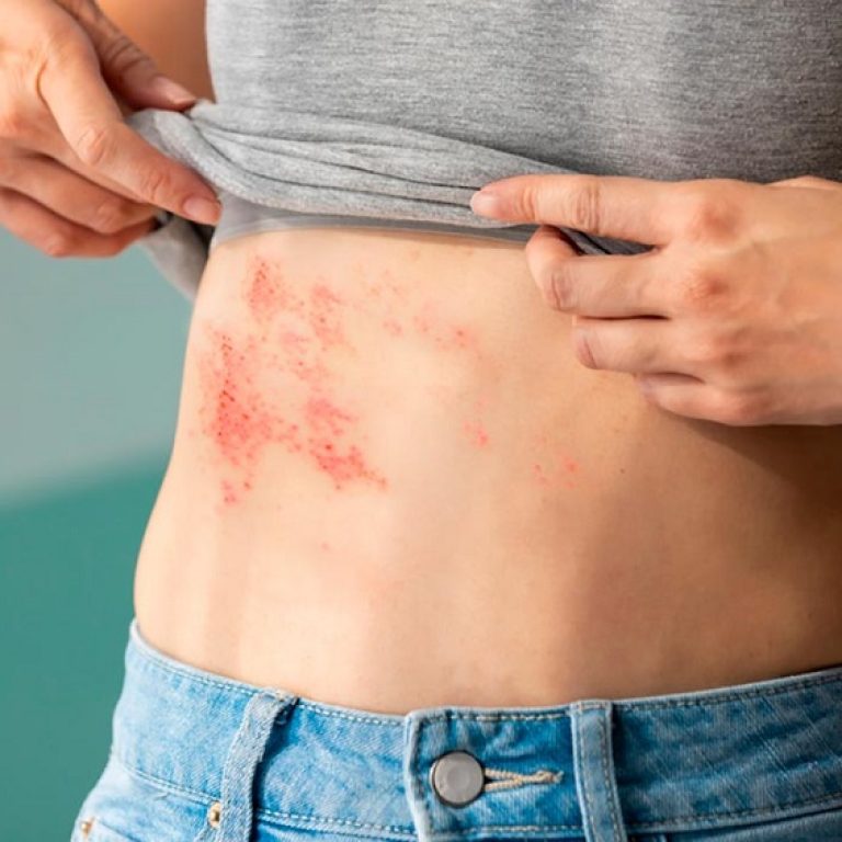 Herpes-zoster-1b