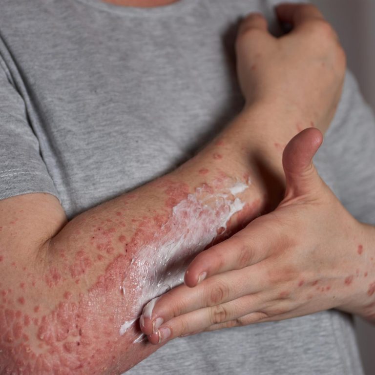 applying-moisturizer-skin-with-psoriasis